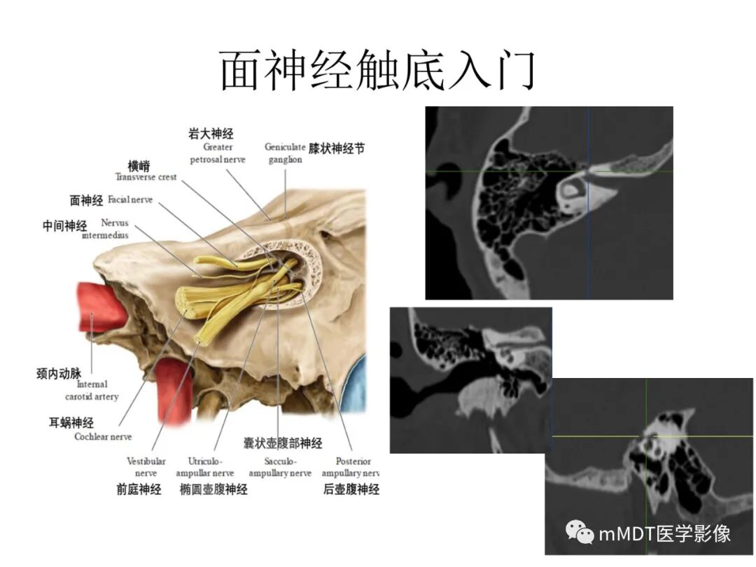 mmd在医学上什么意思触底四神共一门——穿行在内耳道的神经们_https://www.jmylbn.com_新闻资讯_第20张