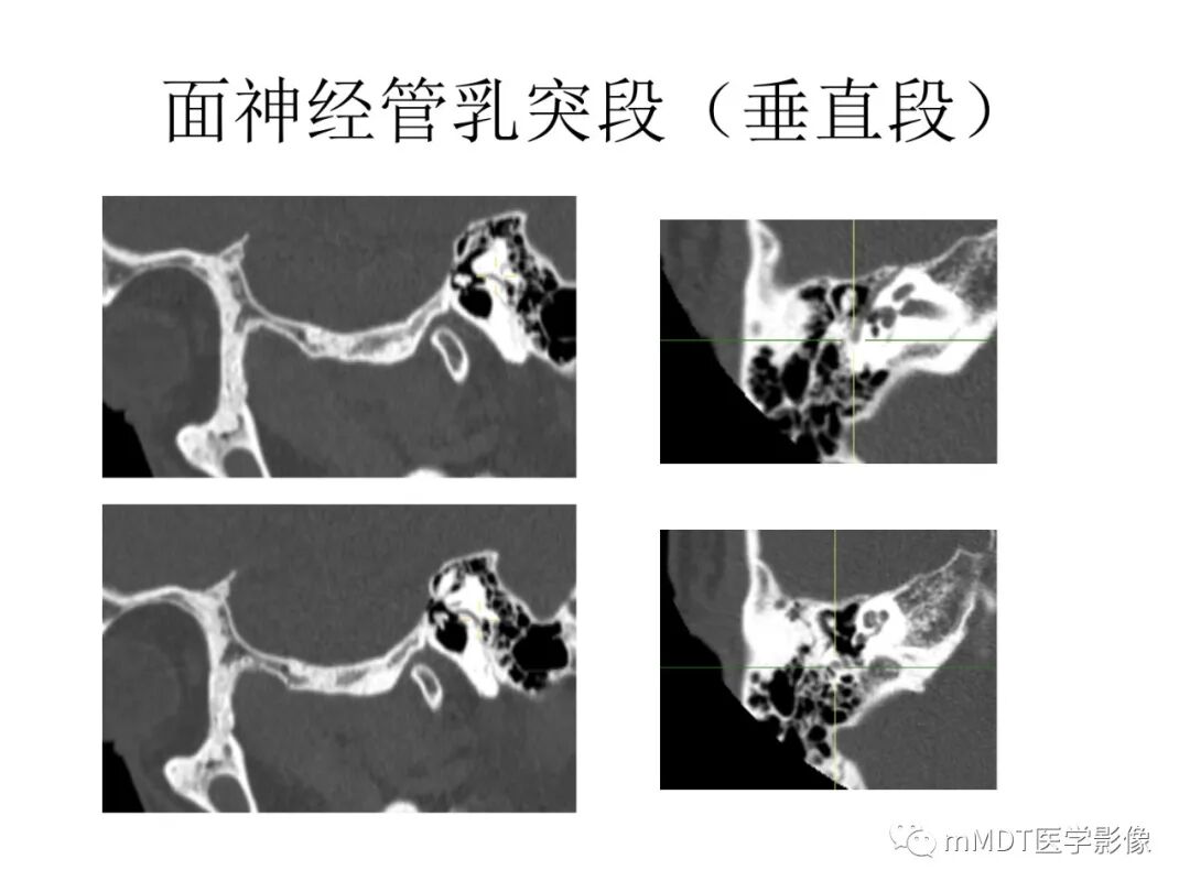 mmd在医学上什么意思触底四神共一门——穿行在内耳道的神经们_https://www.jmylbn.com_新闻资讯_第59张