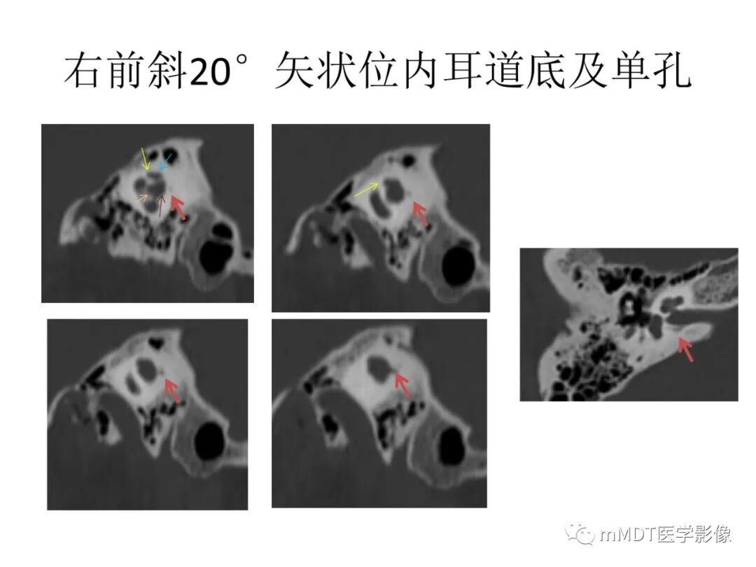 mmd在医学上什么意思触底四神共一门——穿行在内耳道的神经们_https://www.jmylbn.com_新闻资讯_第76张