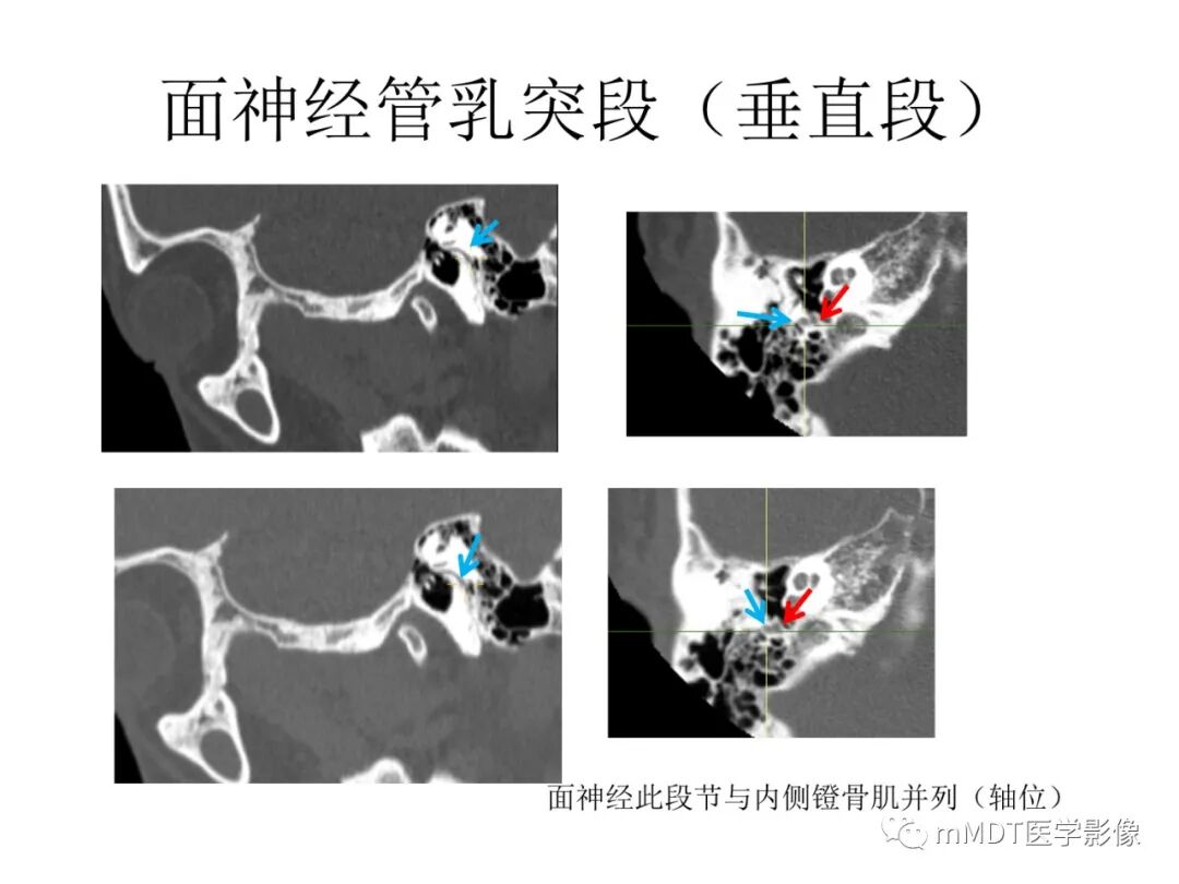 mmd在医学上什么意思触底四神共一门——穿行在内耳道的神经们_https://www.jmylbn.com_新闻资讯_第60张