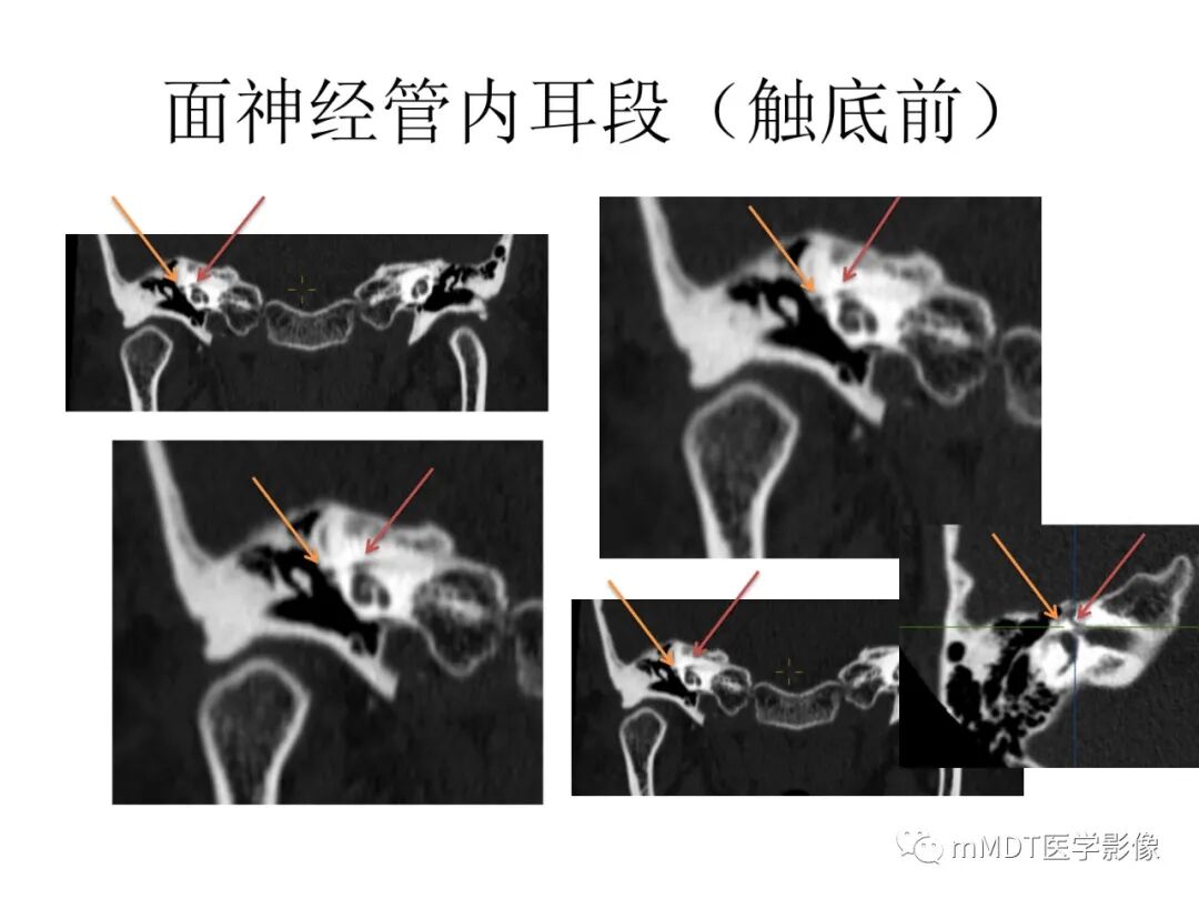 mmd在医学上什么意思触底四神共一门——穿行在内耳道的神经们_https://www.jmylbn.com_新闻资讯_第47张