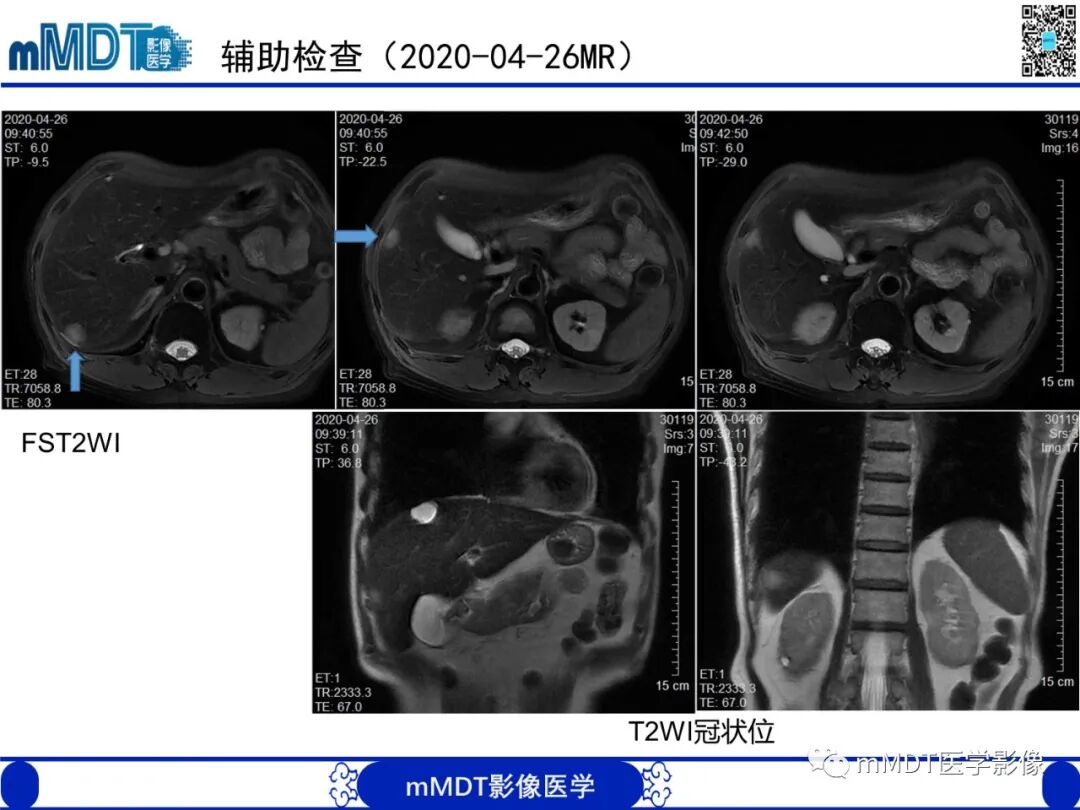 mmd在医学上什么意思嗜酸粒细胞增多综合征_https://www.jmylbn.com_新闻资讯_第7张