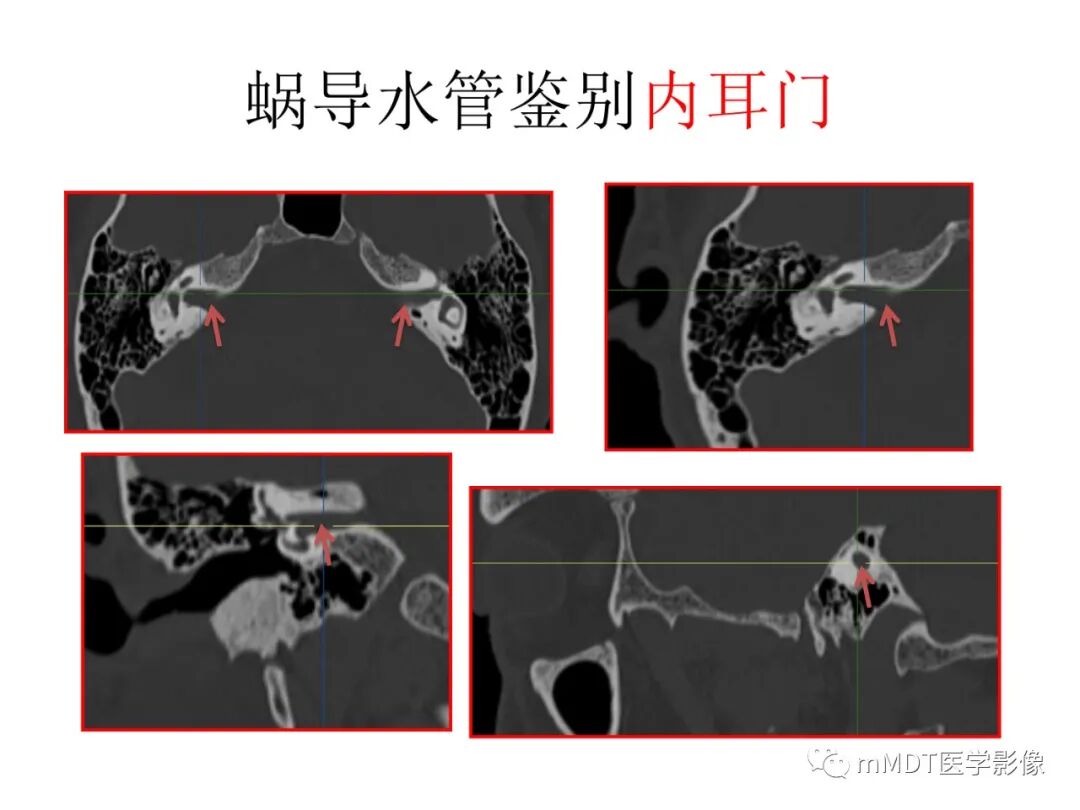mmd在医学上什么意思触底四神共一门——穿行在内耳道的神经们_https://www.jmylbn.com_新闻资讯_第83张