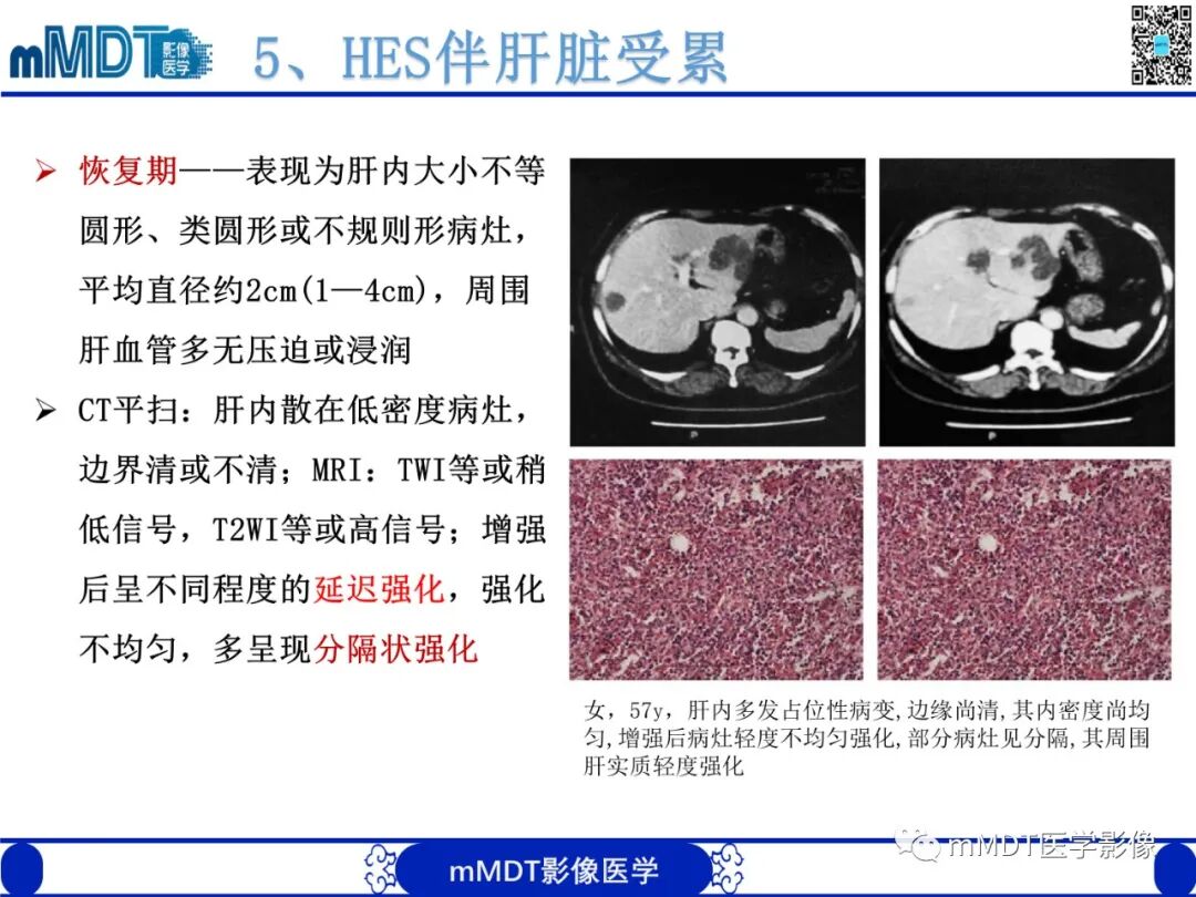 mmd在医学上什么意思嗜酸粒细胞增多综合征_https://www.jmylbn.com_新闻资讯_第26张