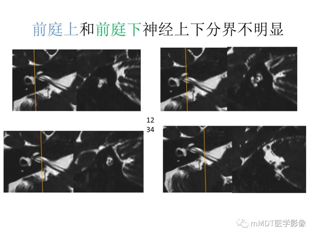 mmd在医学上什么意思触底四神共一门——穿行在内耳道的神经们_https://www.jmylbn.com_新闻资讯_第42张