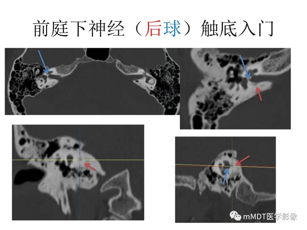 mmd在医学上什么意思触底四神共一门——穿行在内耳道的神经们_https://www.jmylbn.com_新闻资讯_第18张
