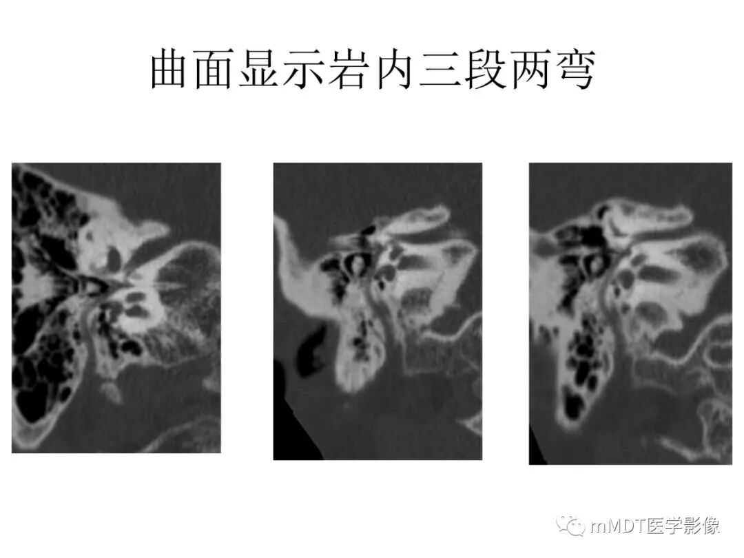 mmd在医学上什么意思触底四神共一门——穿行在内耳道的神经们_https://www.jmylbn.com_新闻资讯_第63张