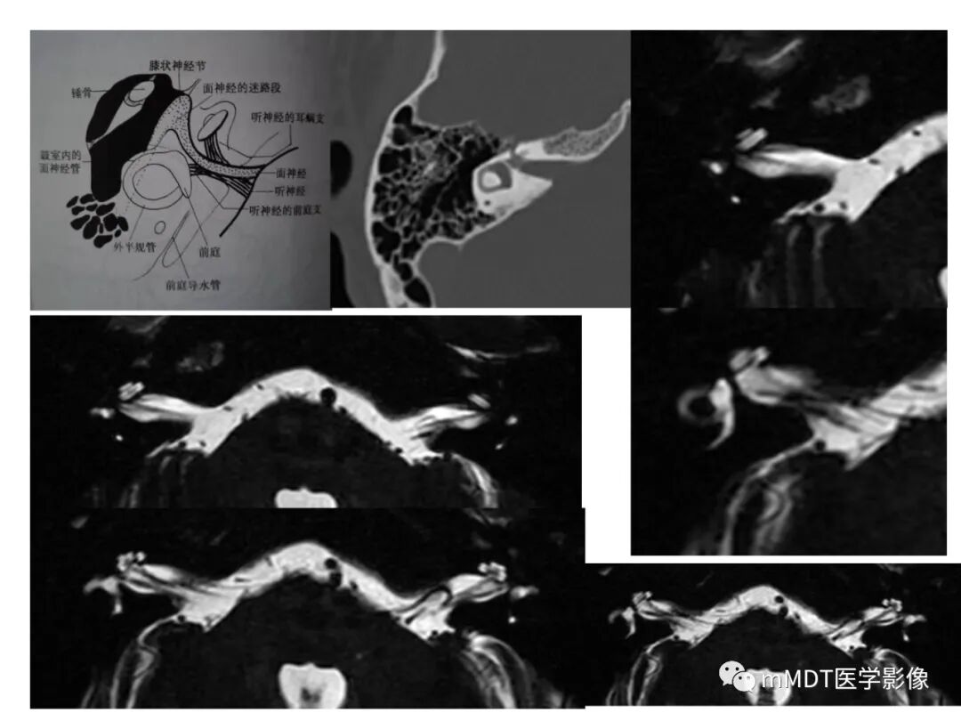 mmd在医学上什么意思触底四神共一门——穿行在内耳道的神经们_https://www.jmylbn.com_新闻资讯_第21张