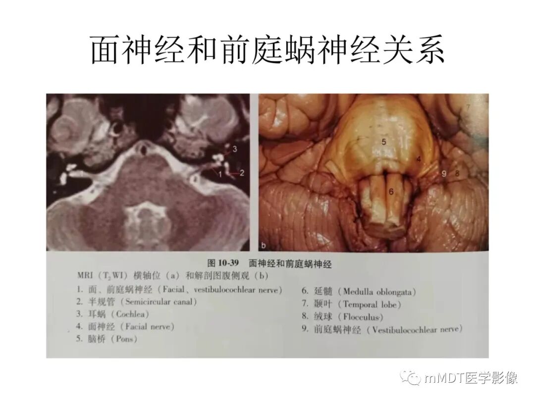 mmd在医学上什么意思触底四神共一门——穿行在内耳道的神经们_https://www.jmylbn.com_新闻资讯_第26张