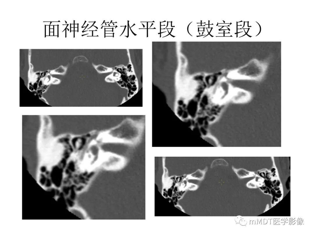 mmd在医学上什么意思触底四神共一门——穿行在内耳道的神经们_https://www.jmylbn.com_新闻资讯_第50张