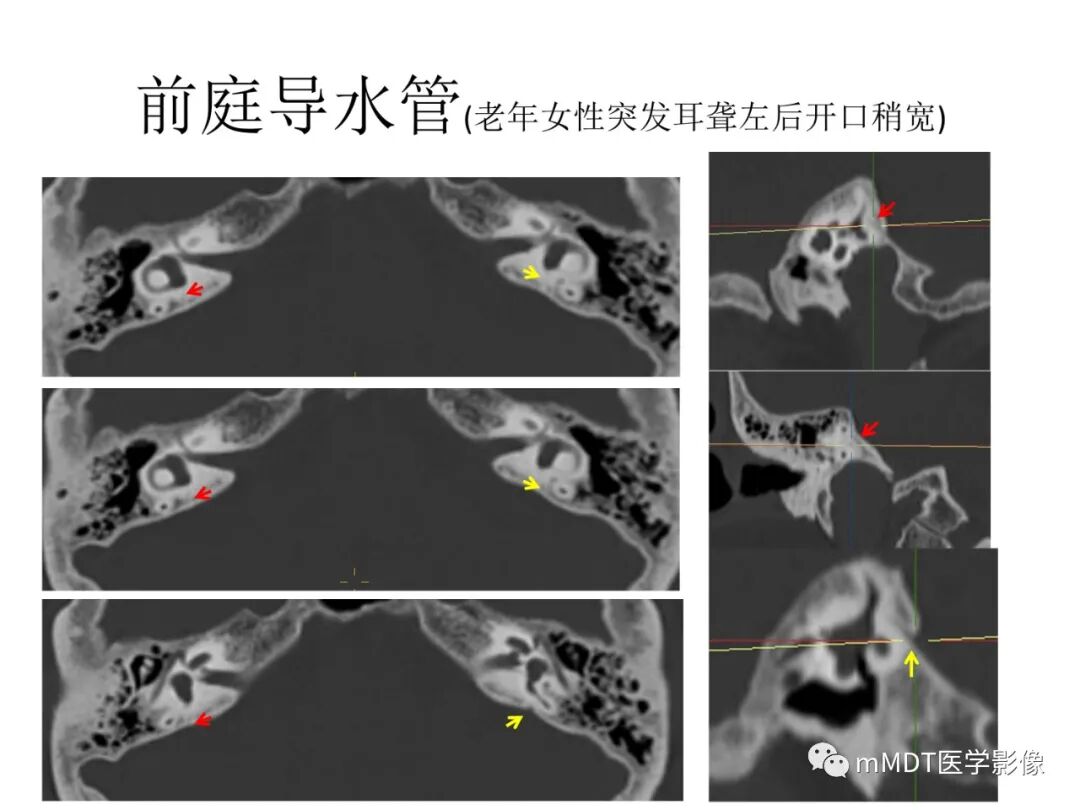 mmd在医学上什么意思触底四神共一门——穿行在内耳道的神经们_https://www.jmylbn.com_新闻资讯_第80张