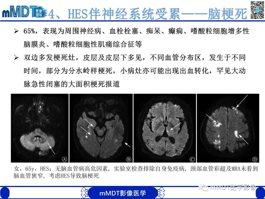 mmd在医学上什么意思嗜酸粒细胞增多综合征_https://www.jmylbn.com_新闻资讯_第23张