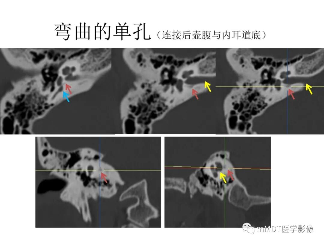 mmd在医学上什么意思触底四神共一门——穿行在内耳道的神经们_https://www.jmylbn.com_新闻资讯_第75张