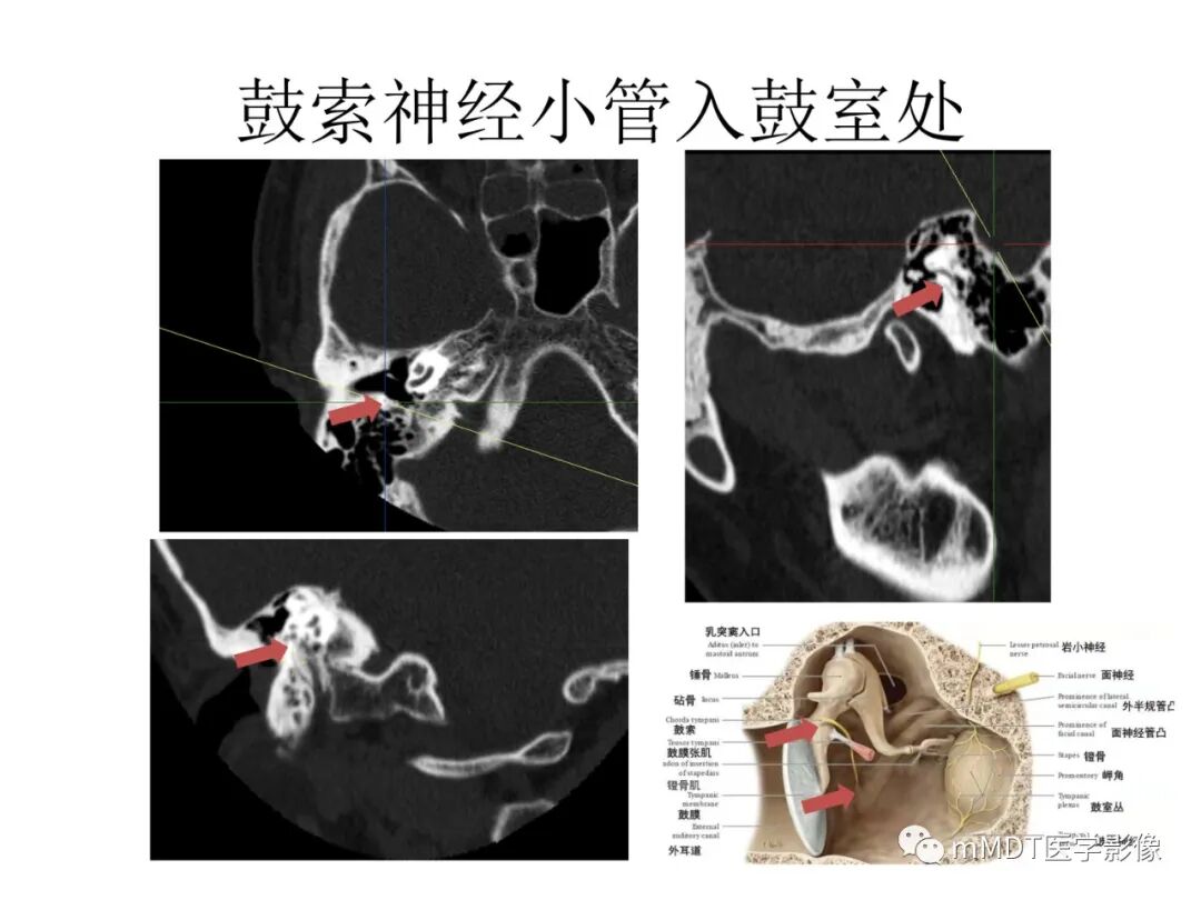 mmd在医学上什么意思触底四神共一门——穿行在内耳道的神经们_https://www.jmylbn.com_新闻资讯_第66张
