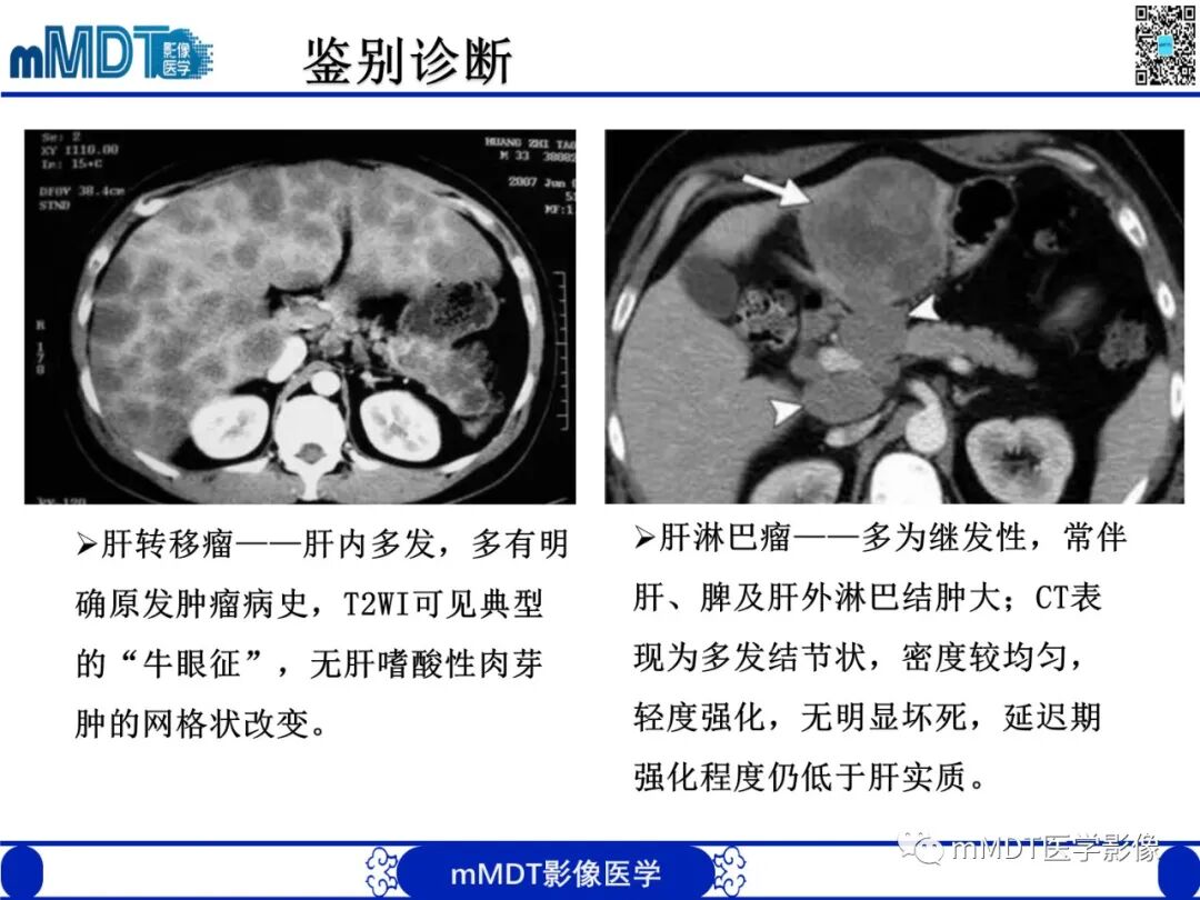 mmd在医学上什么意思嗜酸粒细胞增多综合征_https://www.jmylbn.com_新闻资讯_第29张
