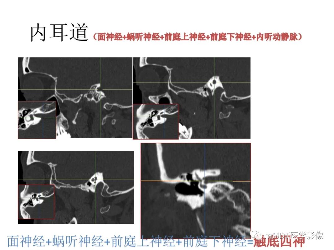mmd在医学上什么意思触底四神共一门——穿行在内耳道的神经们_https://www.jmylbn.com_新闻资讯_第34张