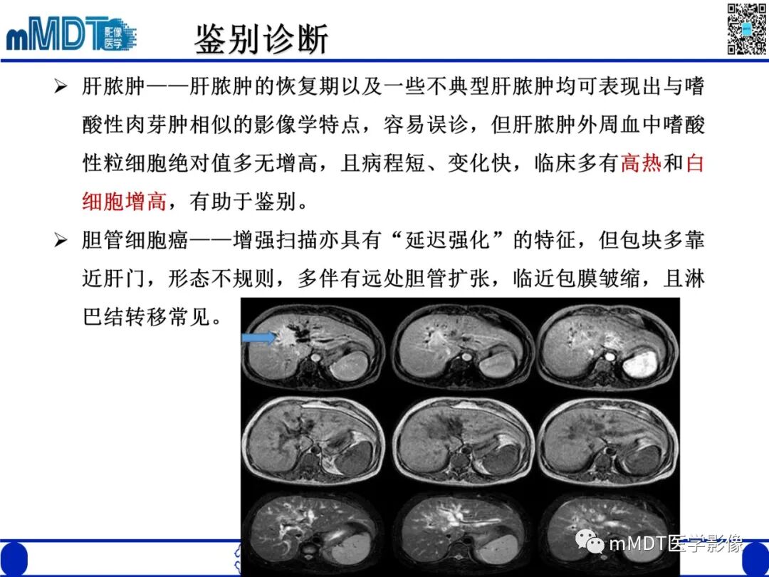 mmd在医学上什么意思嗜酸粒细胞增多综合征_https://www.jmylbn.com_新闻资讯_第28张