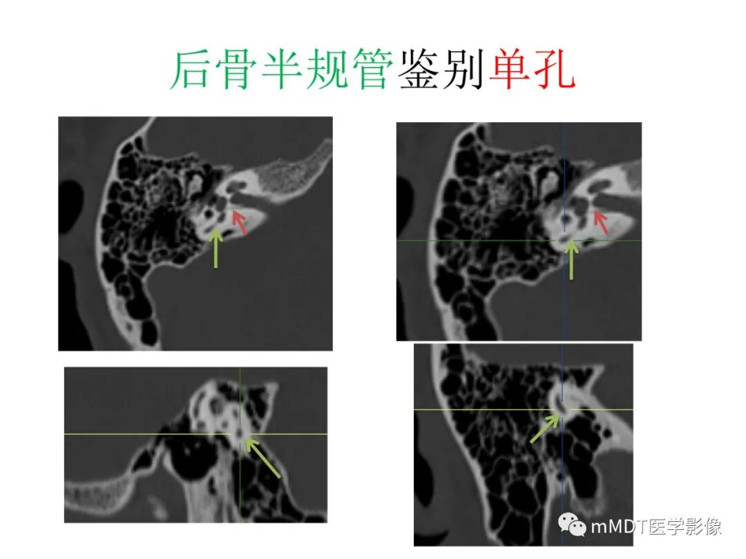 mmd在医学上什么意思触底四神共一门——穿行在内耳道的神经们_https://www.jmylbn.com_新闻资讯_第77张