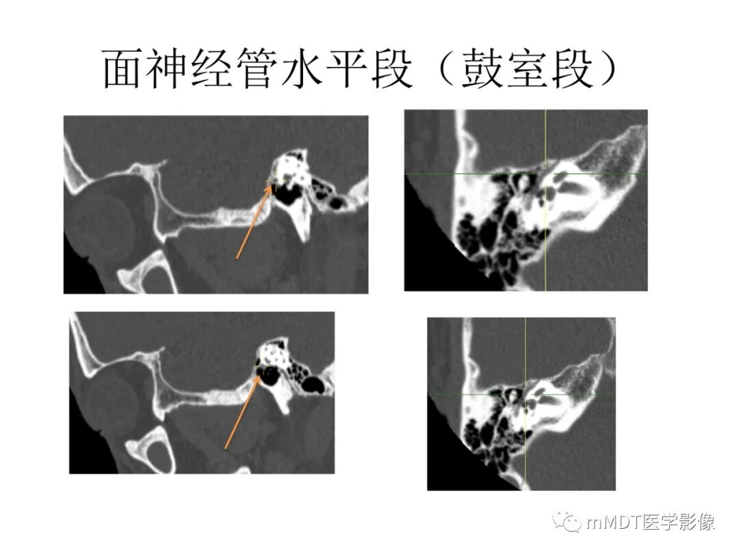 mmd在医学上什么意思触底四神共一门——穿行在内耳道的神经们_https://www.jmylbn.com_新闻资讯_第53张