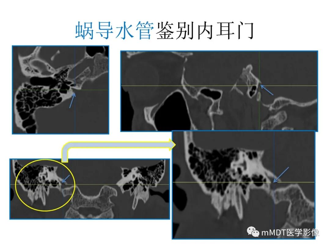 mmd在医学上什么意思触底四神共一门——穿行在内耳道的神经们_https://www.jmylbn.com_新闻资讯_第82张
