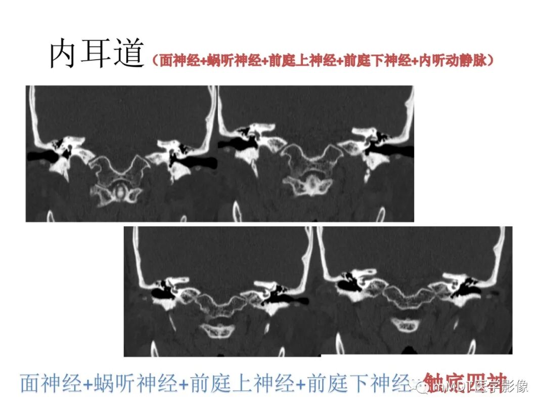 mmd在医学上什么意思触底四神共一门——穿行在内耳道的神经们_https://www.jmylbn.com_新闻资讯_第33张