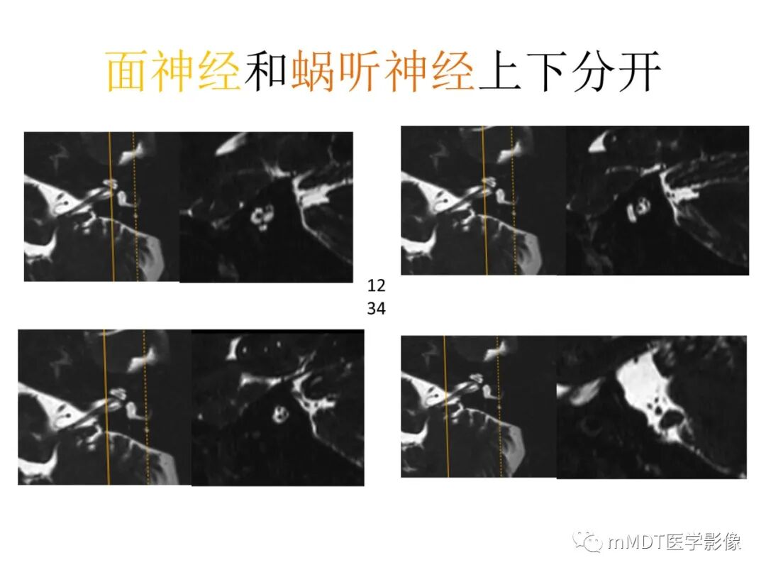 mmd在医学上什么意思触底四神共一门——穿行在内耳道的神经们_https://www.jmylbn.com_新闻资讯_第39张