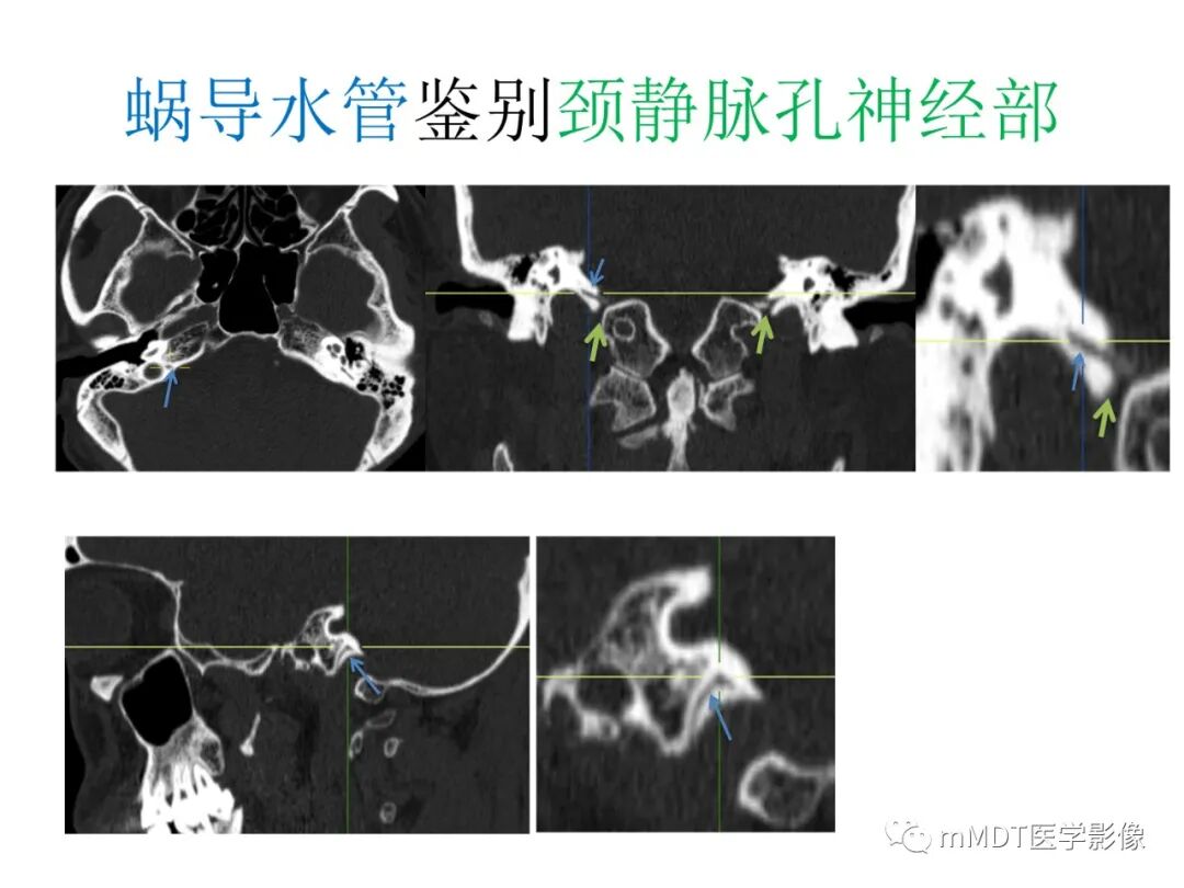 mmd在医学上什么意思触底四神共一门——穿行在内耳道的神经们_https://www.jmylbn.com_新闻资讯_第85张