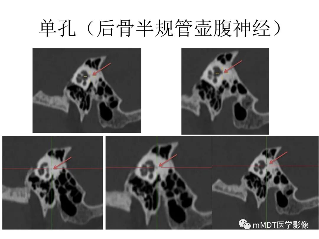 mmd在医学上什么意思触底四神共一门——穿行在内耳道的神经们_https://www.jmylbn.com_新闻资讯_第74张