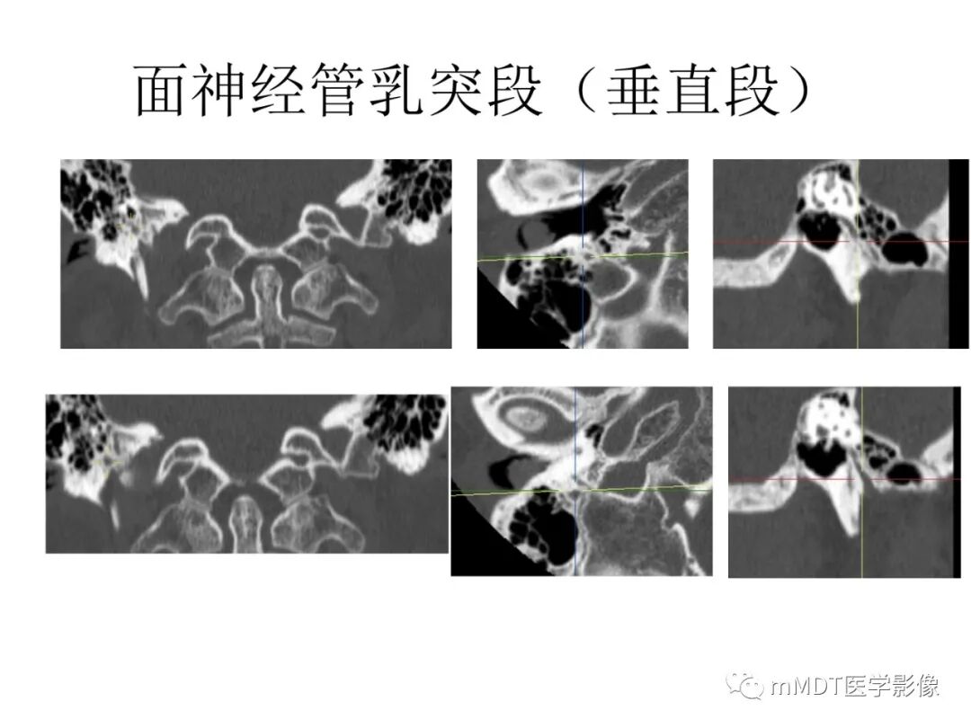 mmd在医学上什么意思触底四神共一门——穿行在内耳道的神经们_https://www.jmylbn.com_新闻资讯_第58张
