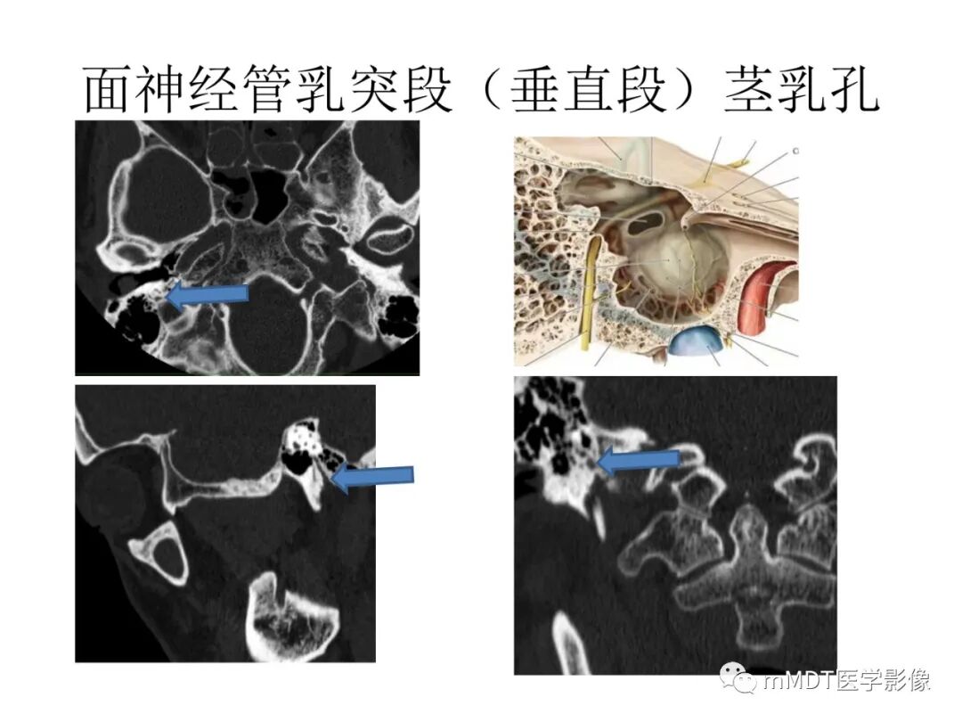 mmd在医学上什么意思触底四神共一门——穿行在内耳道的神经们_https://www.jmylbn.com_新闻资讯_第62张