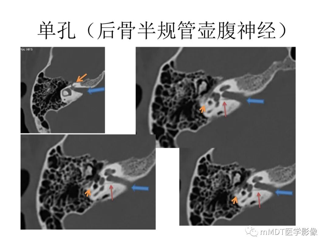 mmd在医学上什么意思触底四神共一门——穿行在内耳道的神经们_https://www.jmylbn.com_新闻资讯_第72张