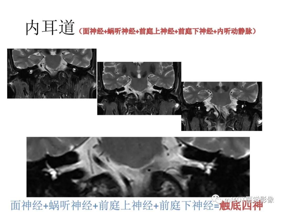mmd在医学上什么意思触底四神共一门——穿行在内耳道的神经们_https://www.jmylbn.com_新闻资讯_第37张