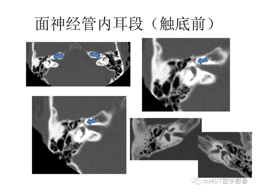 mmd在医学上什么意思触底四神共一门——穿行在内耳道的神经们_https://www.jmylbn.com_新闻资讯_第45张