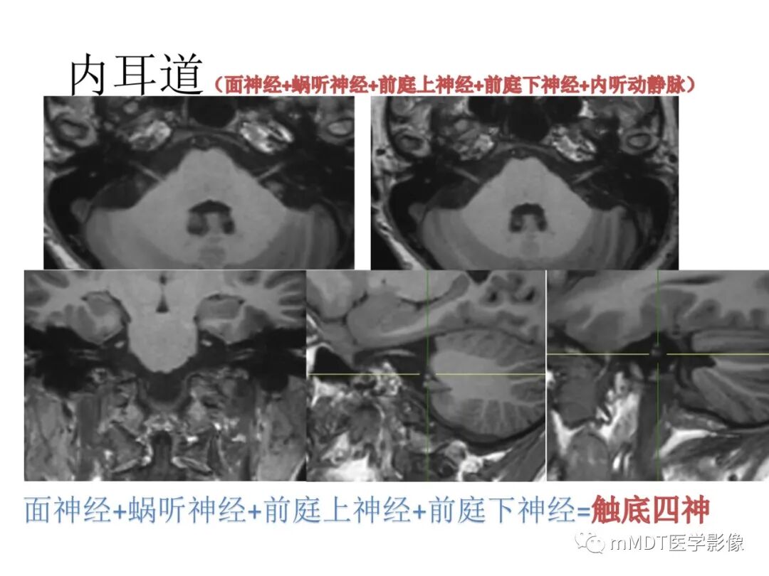 mmd在医学上什么意思触底四神共一门——穿行在内耳道的神经们_https://www.jmylbn.com_新闻资讯_第36张