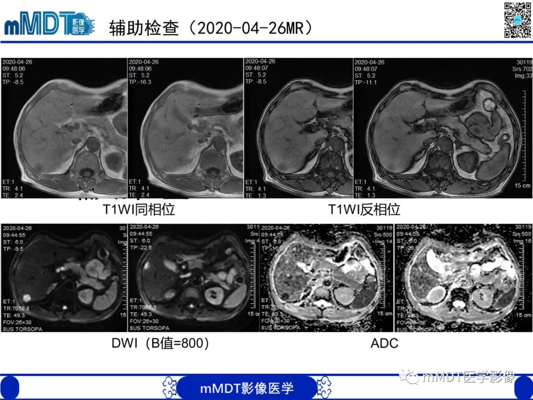 mmd在医学上什么意思嗜酸粒细胞增多综合征_https://www.jmylbn.com_新闻资讯_第8张