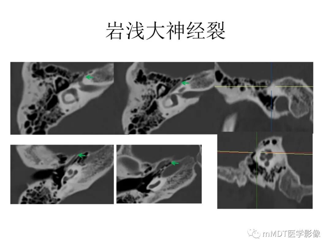 mmd在医学上什么意思触底四神共一门——穿行在内耳道的神经们_https://www.jmylbn.com_新闻资讯_第68张