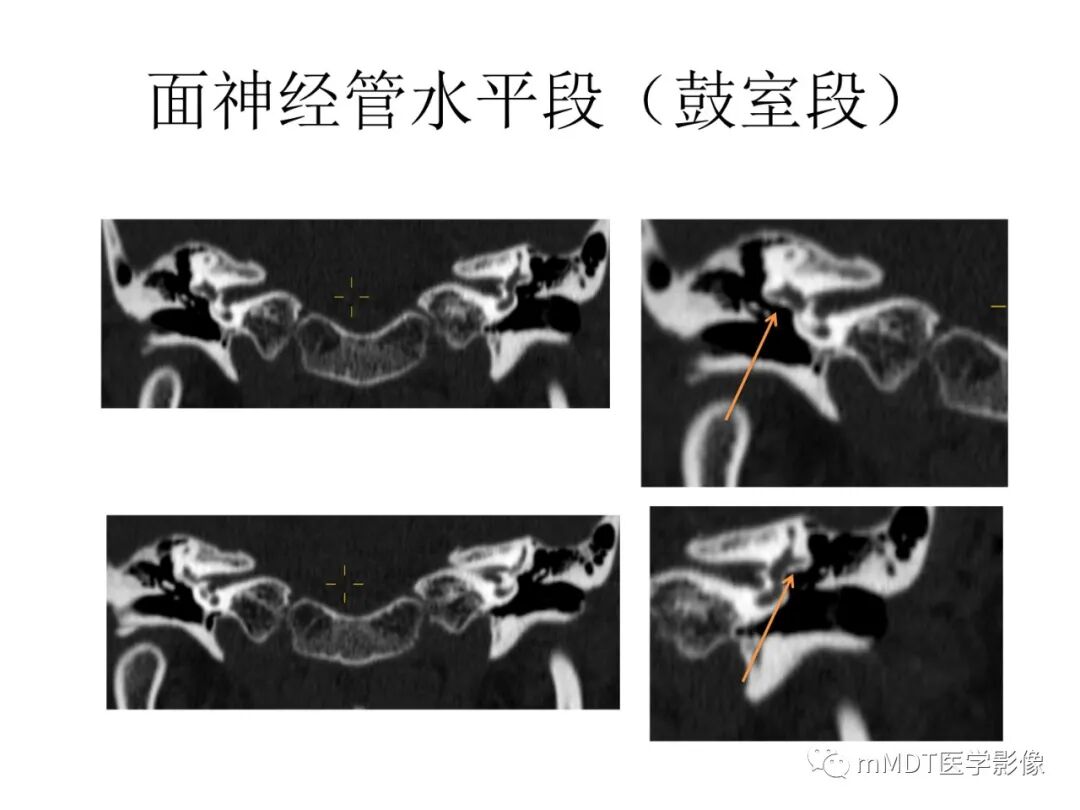 mmd在医学上什么意思触底四神共一门——穿行在内耳道的神经们_https://www.jmylbn.com_新闻资讯_第52张