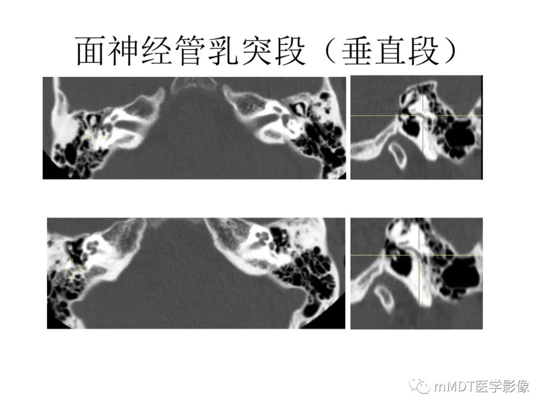 mmd在医学上什么意思触底四神共一门——穿行在内耳道的神经们_https://www.jmylbn.com_新闻资讯_第55张