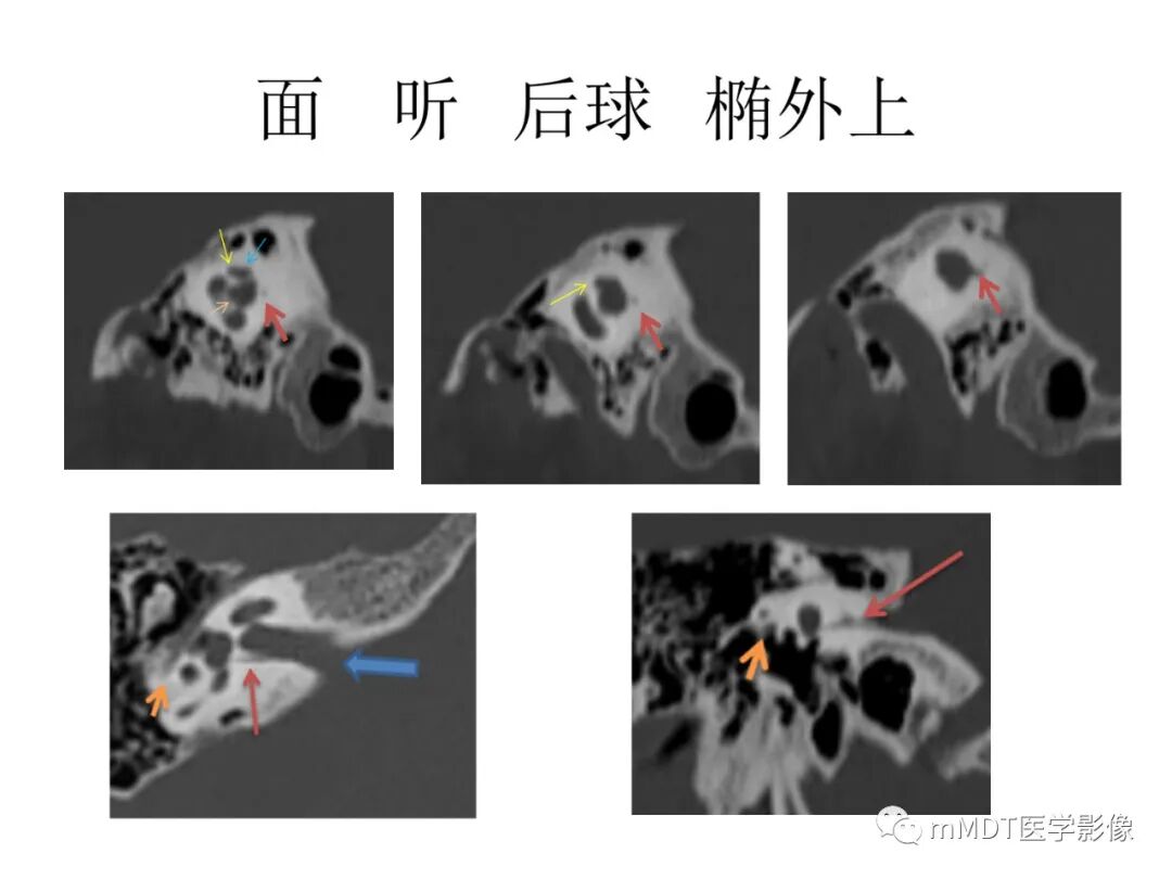 mmd在医学上什么意思触底四神共一门——穿行在内耳道的神经们_https://www.jmylbn.com_新闻资讯_第25张