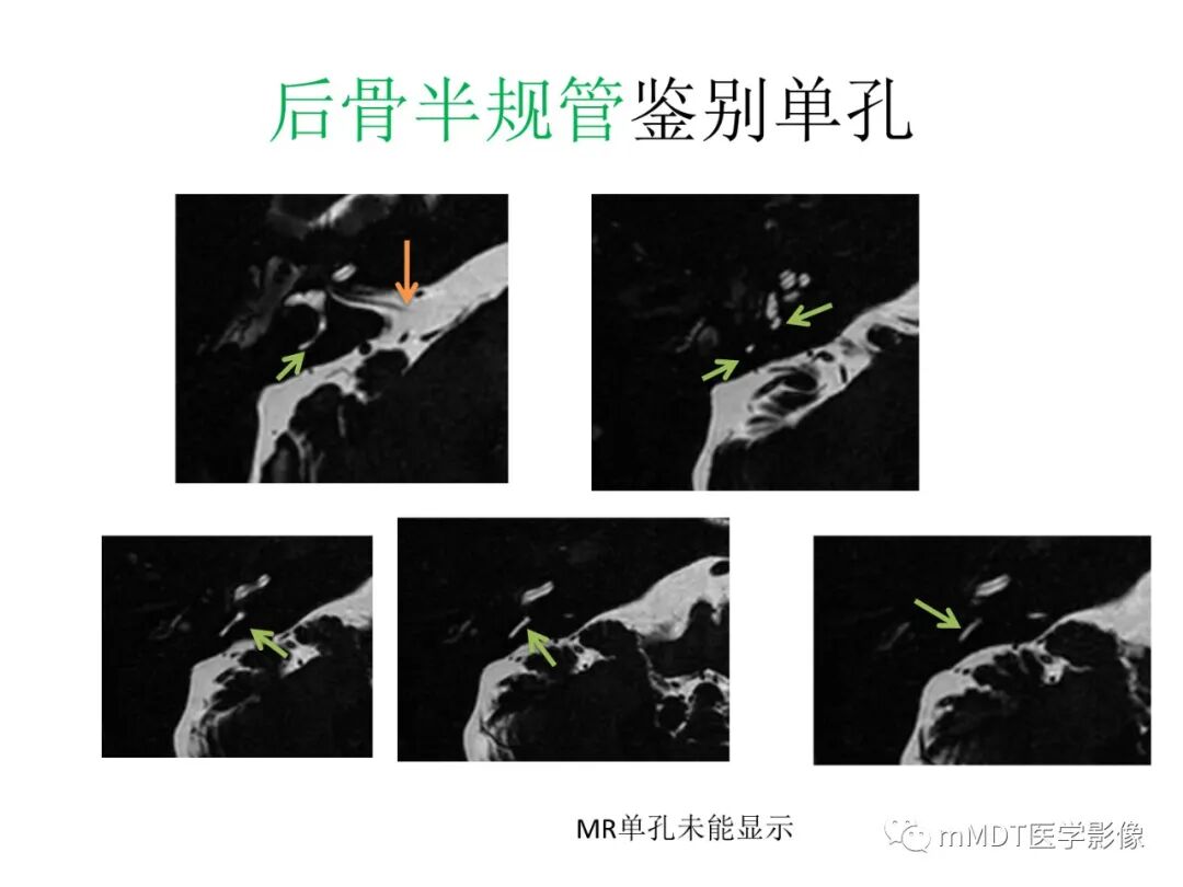 mmd在医学上什么意思触底四神共一门——穿行在内耳道的神经们_https://www.jmylbn.com_新闻资讯_第78张