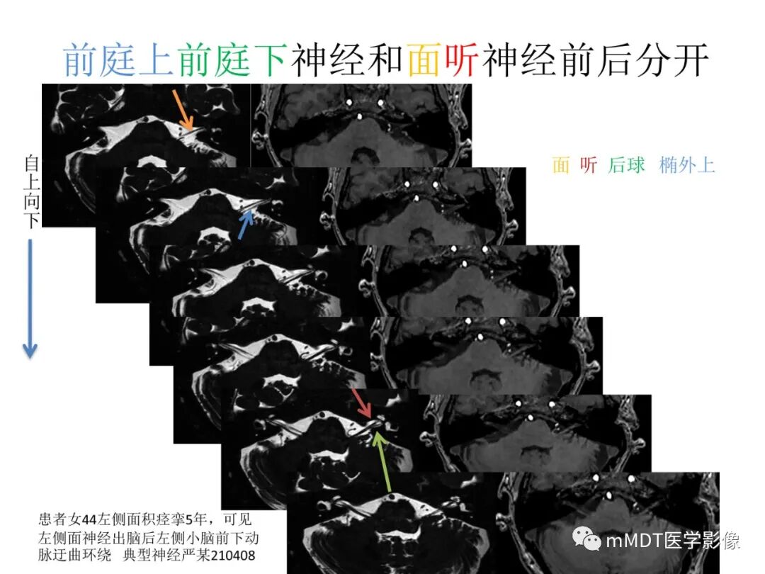 mmd在医学上什么意思触底四神共一门——穿行在内耳道的神经们_https://www.jmylbn.com_新闻资讯_第40张