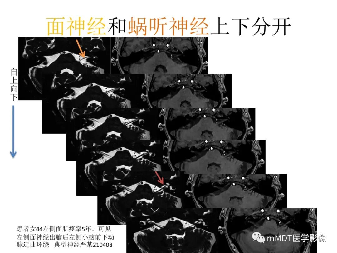mmd在医学上什么意思触底四神共一门——穿行在内耳道的神经们_https://www.jmylbn.com_新闻资讯_第38张