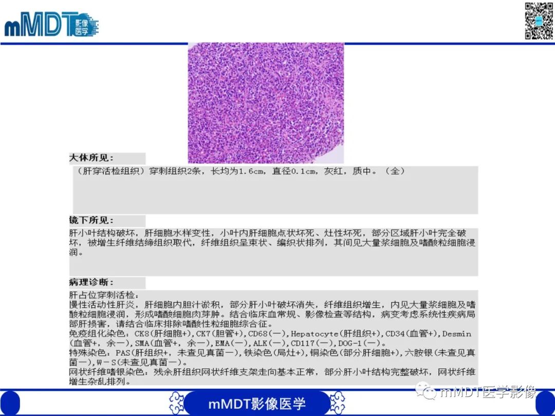 mmd在医学上什么意思嗜酸粒细胞增多综合征_https://www.jmylbn.com_新闻资讯_第11张
