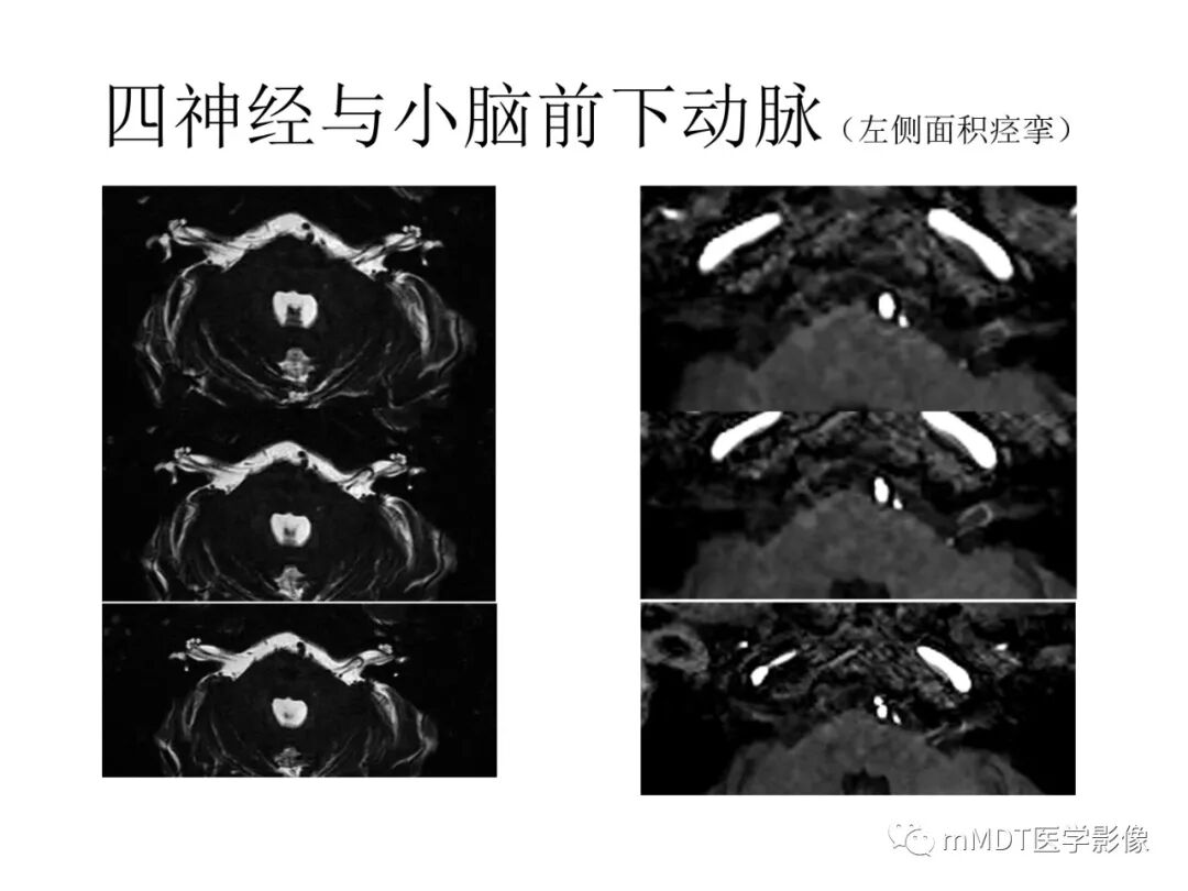 mmd在医学上什么意思触底四神共一门——穿行在内耳道的神经们_https://www.jmylbn.com_新闻资讯_第30张