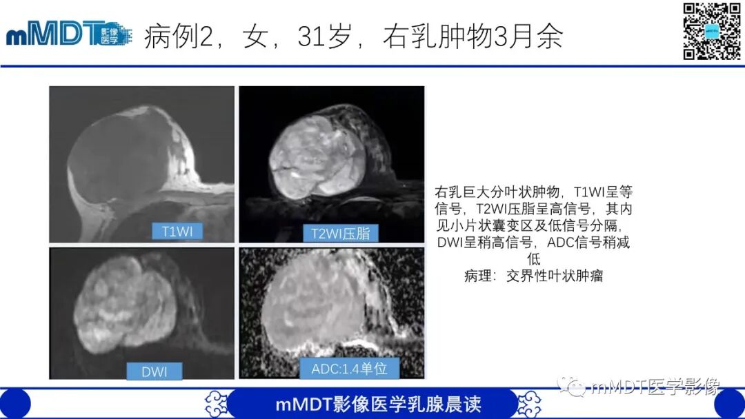 mmd在医学上什么意思乳腺叶状瘤病例分析--李凤陈_https://www.jmylbn.com_新闻资讯_第19张