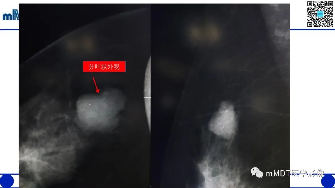 mmd在医学上什么意思乳腺叶状瘤病例分析--李凤陈_https://www.jmylbn.com_新闻资讯_第11张