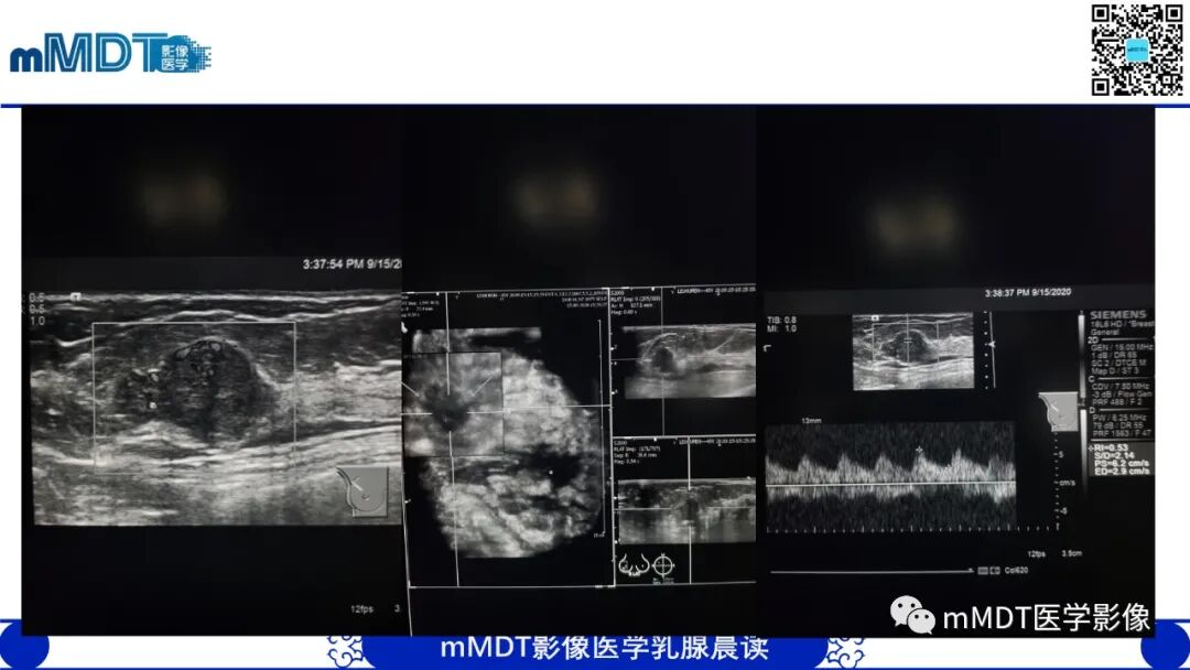 mmd在医学上什么意思乳腺叶状瘤病例分析--李凤陈_https://www.jmylbn.com_新闻资讯_第6张