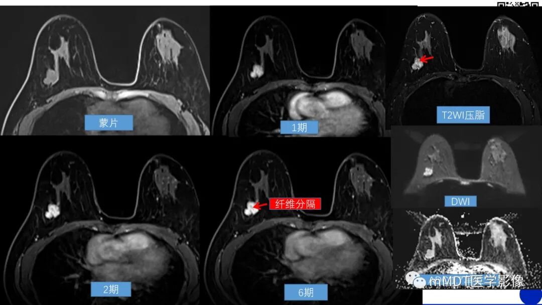 mmd在医学上什么意思乳腺叶状瘤病例分析--李凤陈_https://www.jmylbn.com_新闻资讯_第10张