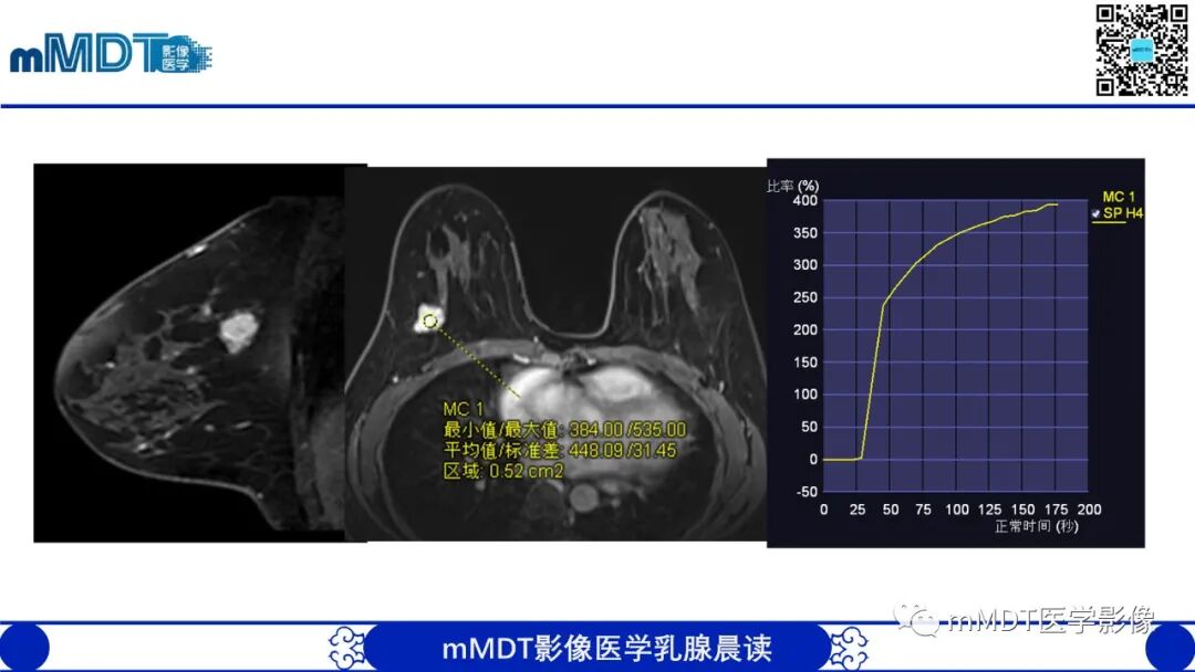 mmd在医学上什么意思乳腺叶状瘤病例分析--李凤陈_https://www.jmylbn.com_新闻资讯_第8张