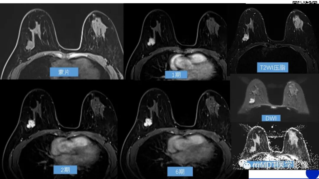 mmd在医学上什么意思乳腺叶状瘤病例分析--李凤陈_https://www.jmylbn.com_新闻资讯_第7张